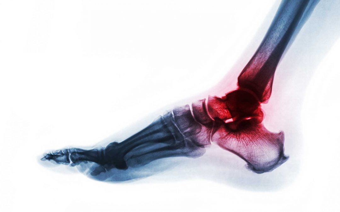 Best CBD Products for Arthritis & Pain
